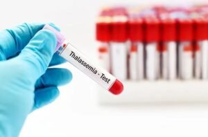 Mengenal Penyakit Talasemia: Penyebab, Gejala dan Cara Mencegahnya